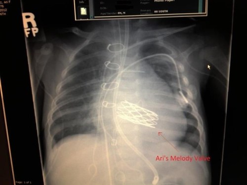 Melody valve in mitral position